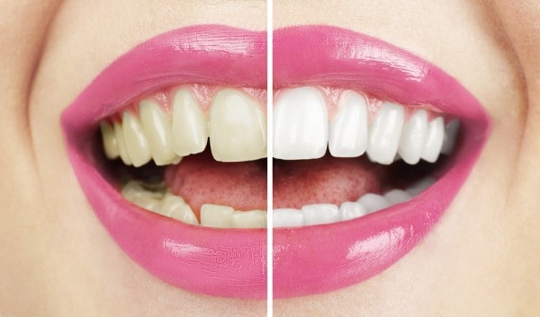 What Early Signs of Oral Cancer Should You Never Ignore Didcot?