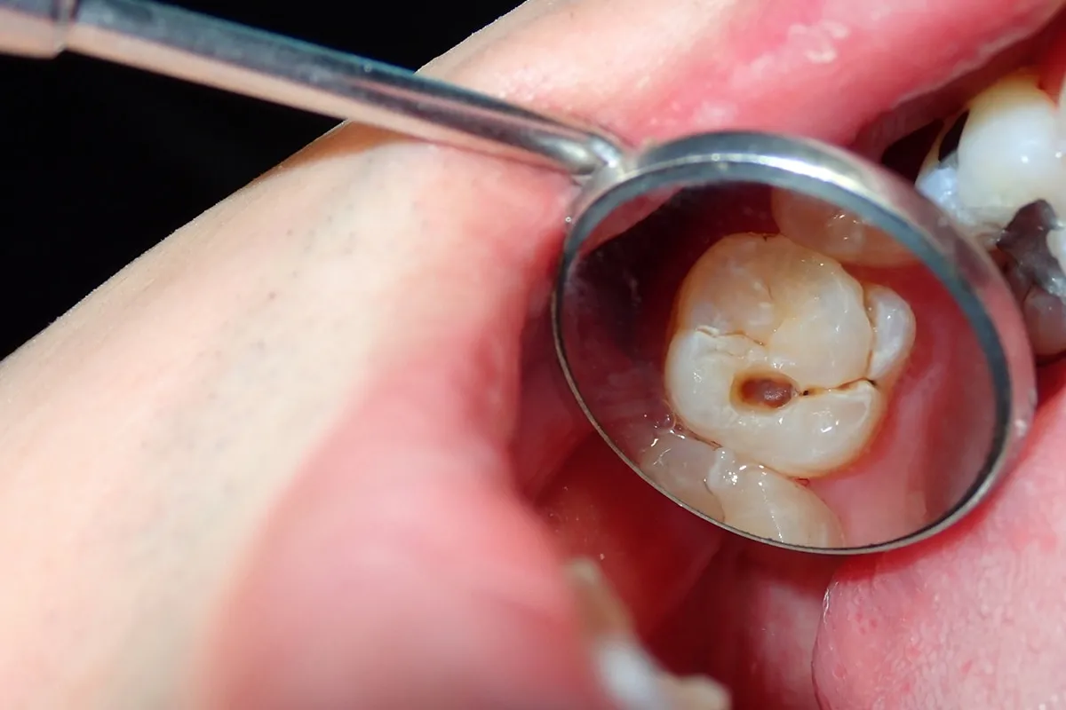 Why Do Teeth Crack? Common Causes to Know Didcot