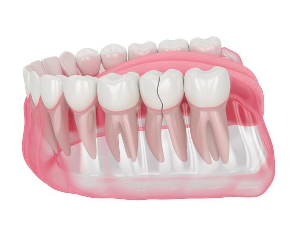 How Can You Manage Pain and Discomfort After a Root Canal Didcot?