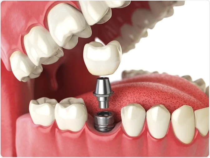 How Do I Decide Which Tooth Replacement Is Right for Me Didcot?