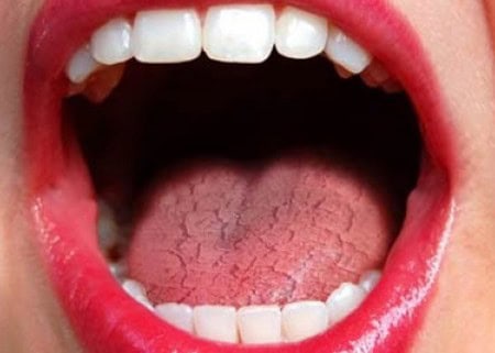 Dry Mouth and Its Role in Tooth Decay Didcot