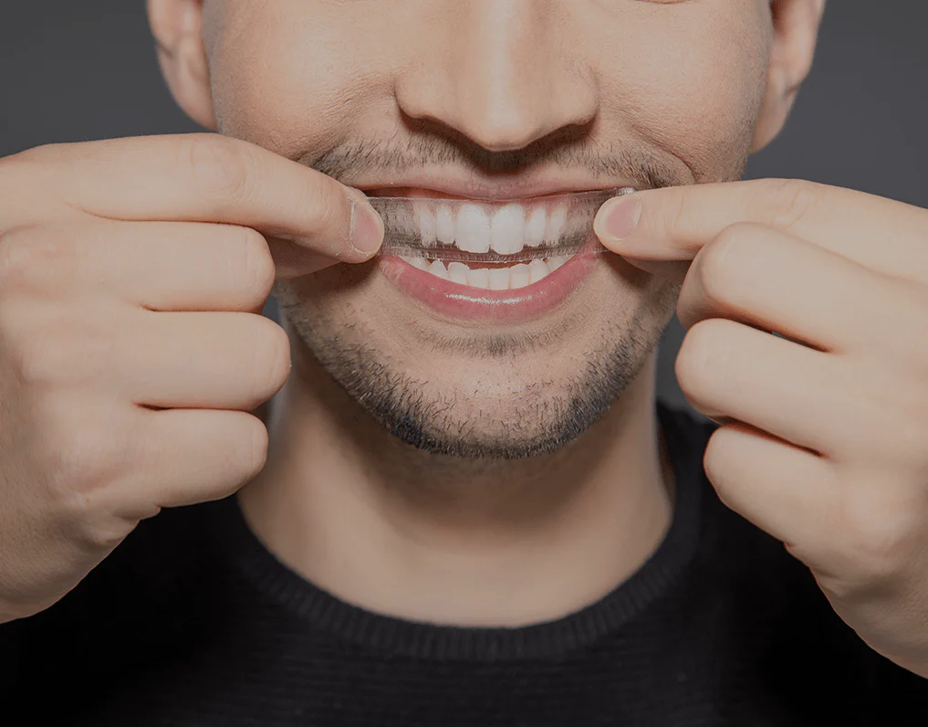 What to Consider Before Choosing a Teeth Whitening Option Didcot