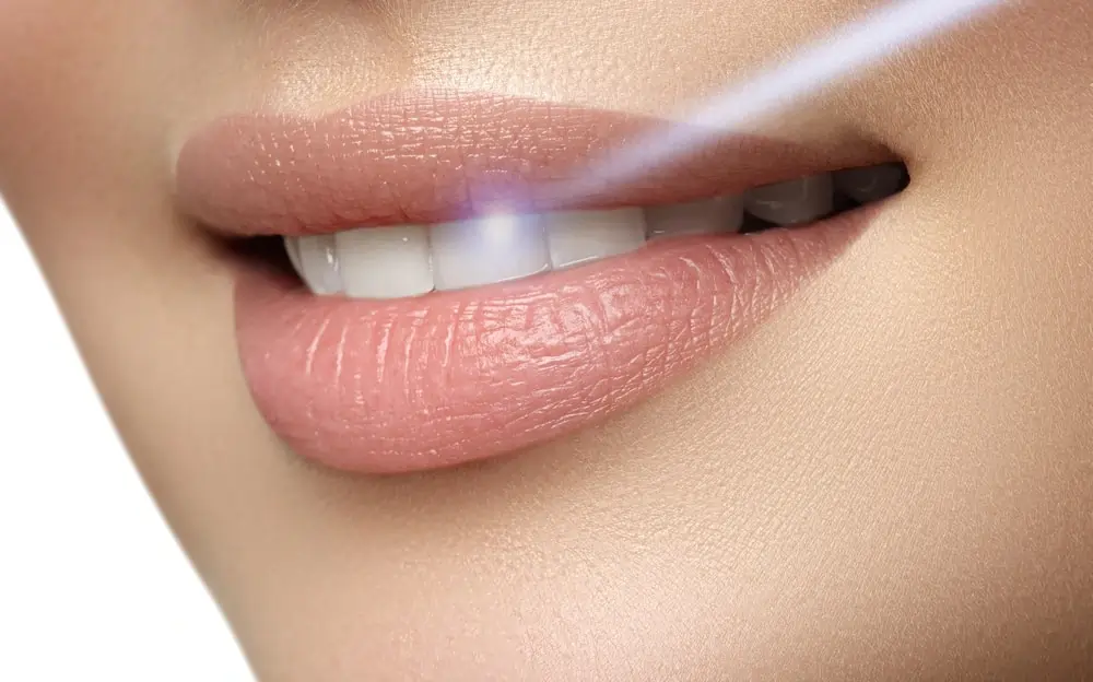 How Long Does Laser Teeth Whitening Last on Your Teeth Didcot?