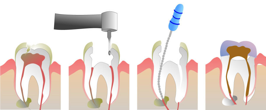 How Do You Properly Care for Your Teeth After a Root Canal Didcot