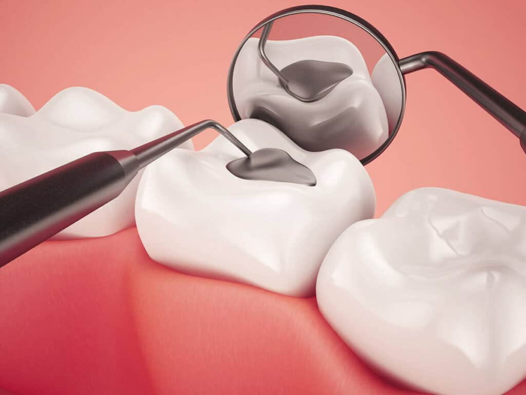 How Can You Prevent Tooth Decay Effectively Didcot