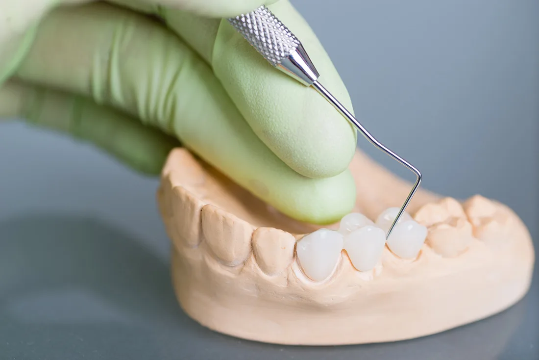 Do Braces Take Years to Show Results Didcot