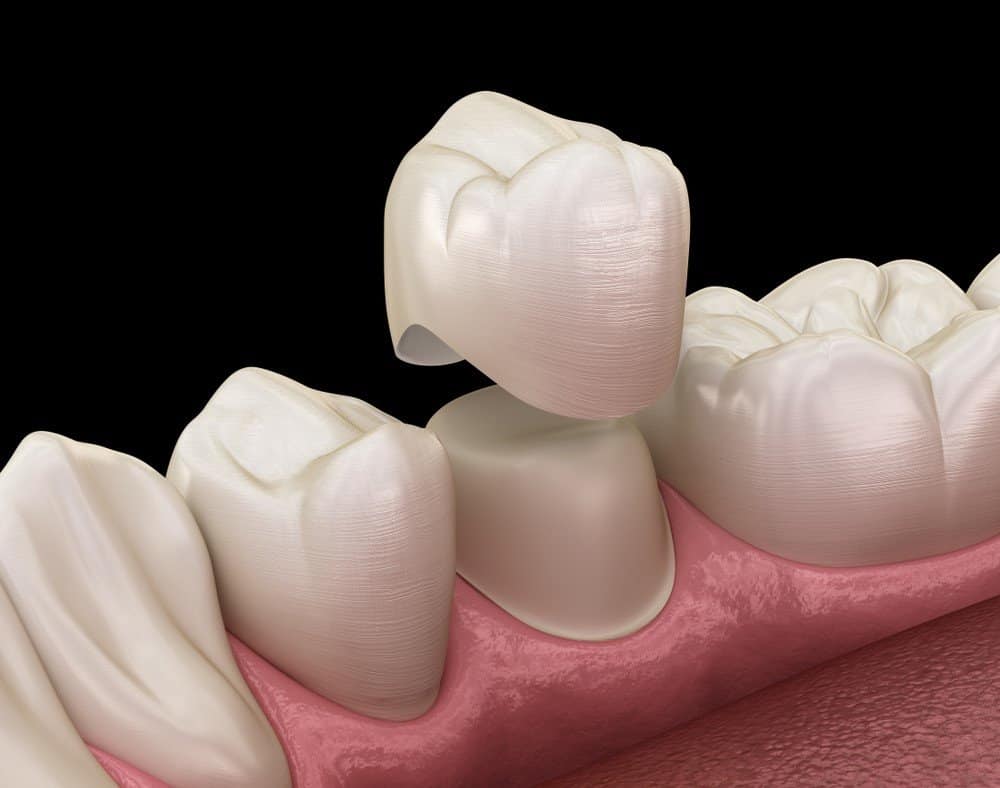 What Daily Habits Help Protect Your Dental Crowns Didcot?