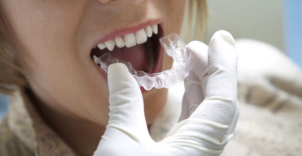 Can Bruxism Affect Your Sleep Quality Didcot